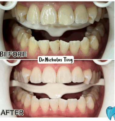 Dental Teeth Whitening – SK Dental