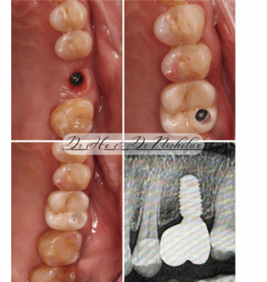 Dental Implants: Restore Your Smile & Lifestyle | SK Dental